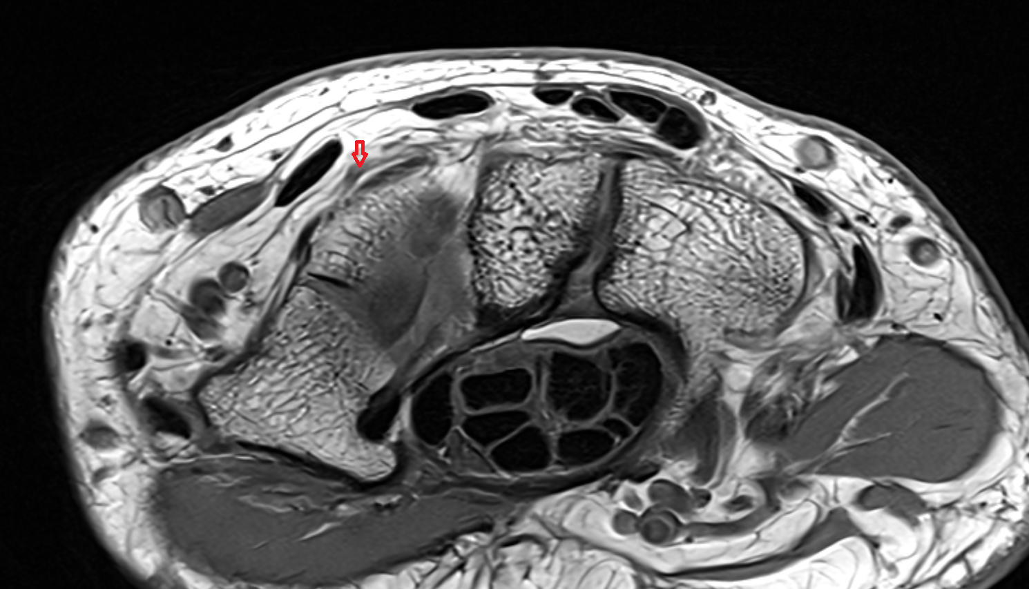 dorsal carpal branch of the radial artery axial cross sectional anatomy 3T MRI AI enhanced radiology image-img-00000-00000_00001