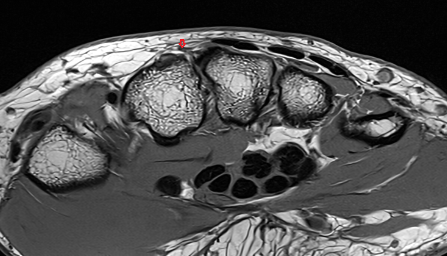 dorsal carpal branch of the radial artery axial cross sectional anatomy 3T MRI AI enhanced radiology image-img-00000-00000_00002