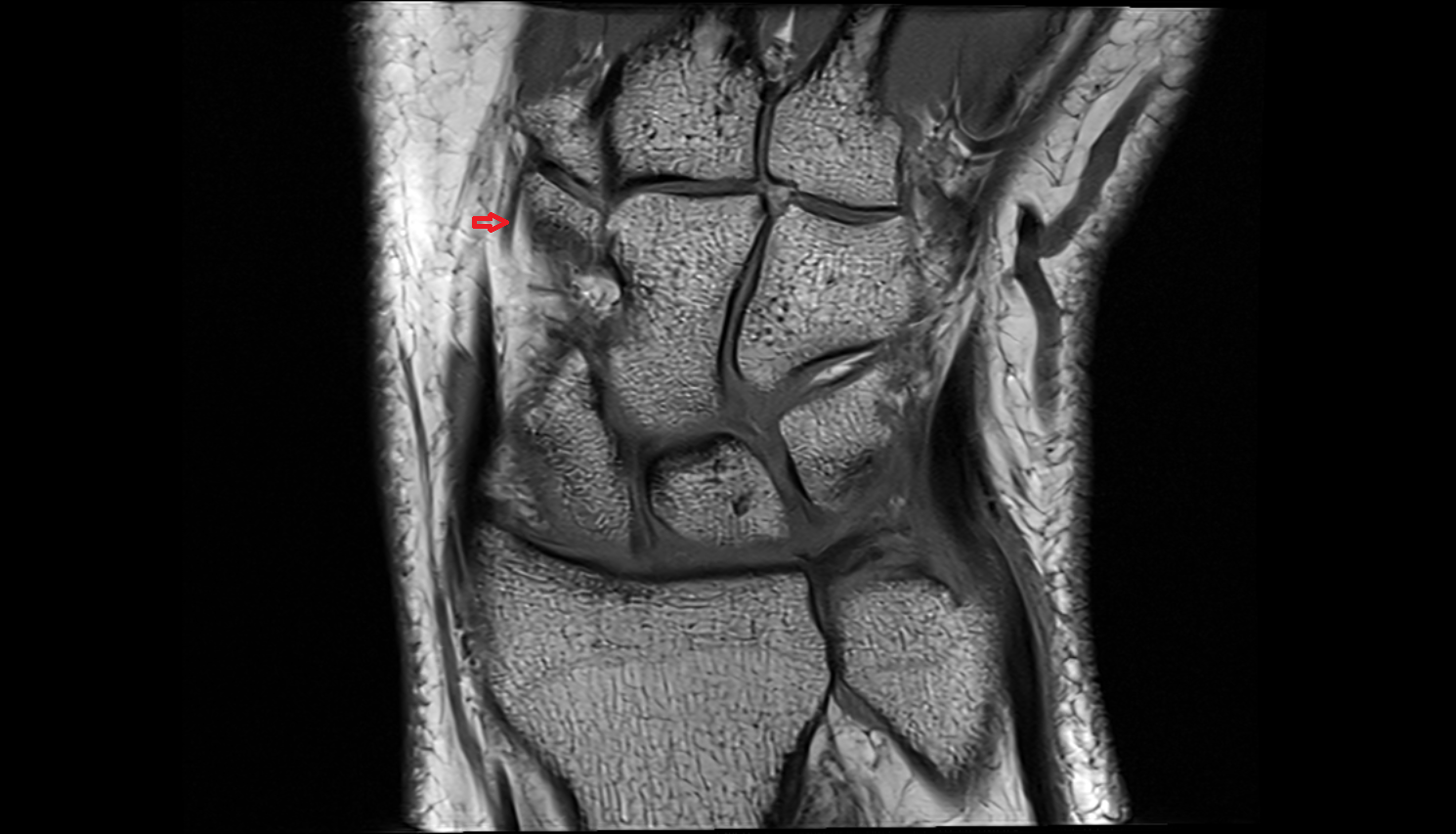 dorsal carpal branch of the radial artery coronal cross sectional anatomy 3T MRI AI enhanced radiology image-img-00000-00000