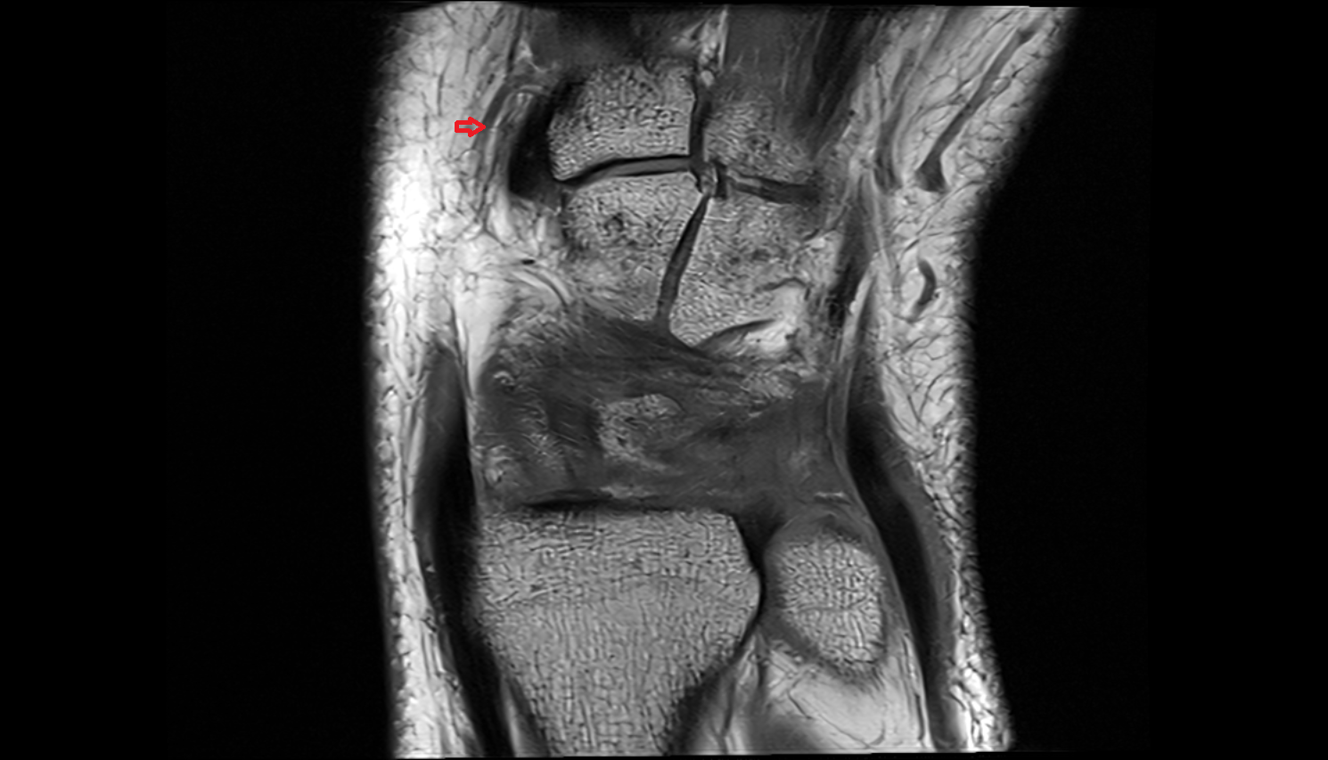 dorsal carpal branch of the radial artery coronal cross sectional anatomy 3T MRI AI enhanced radiology image-img-00000-00000_00001