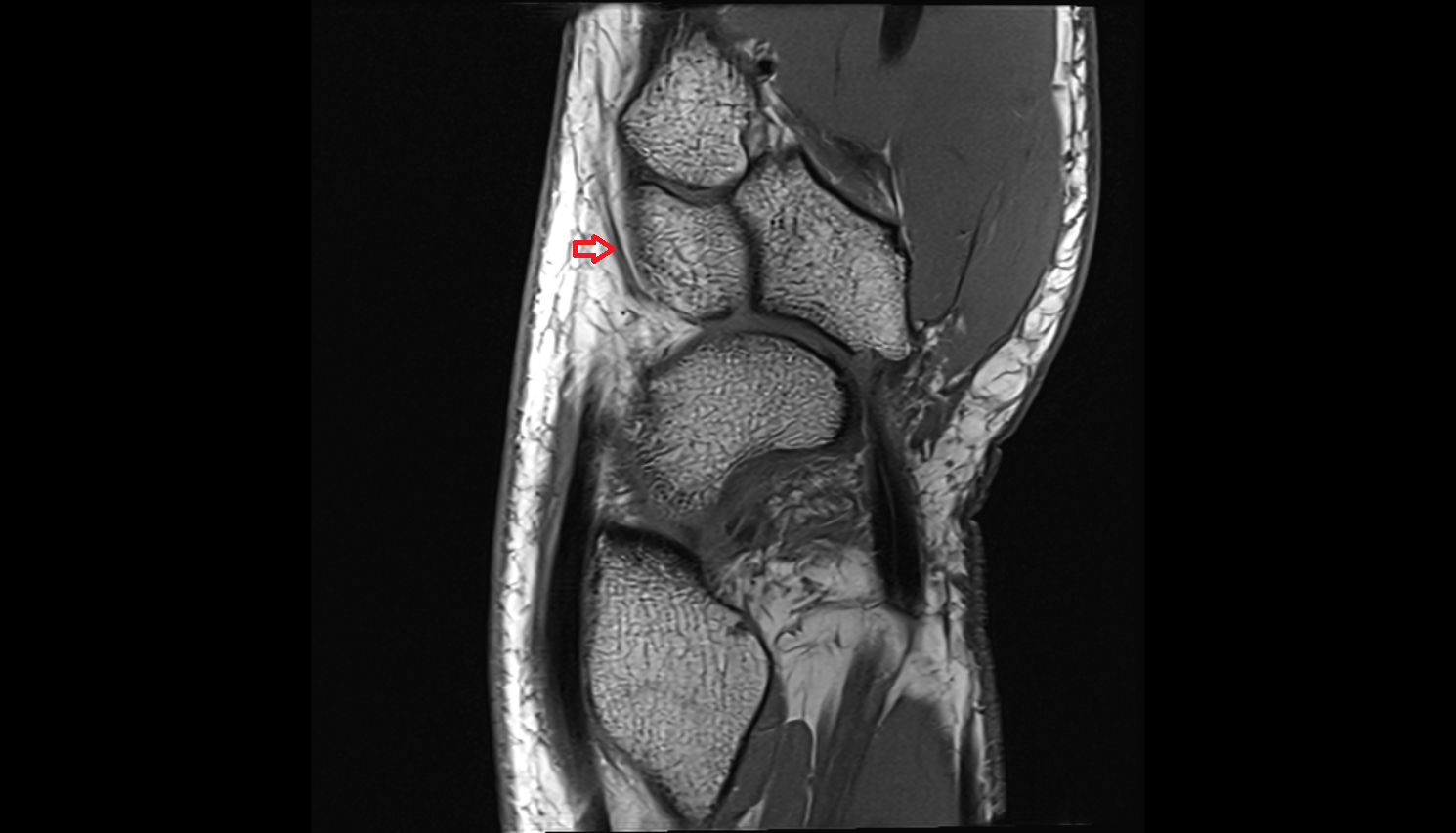 dorsal carpal branch of the radial artery sag cross sectional anatomy 3T MRI AI enhanced radiology image-img-00000-00000