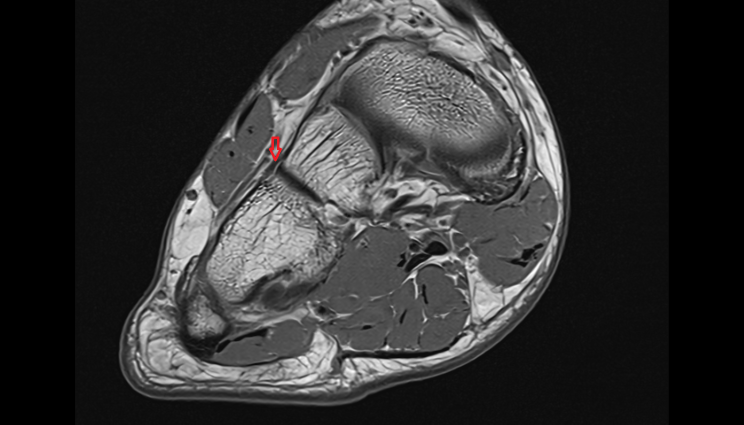 dorsal cuneocuboid ligament axial  cross sectional anatomy 3T MRI AI enhanced radiology image-img-00000-00000