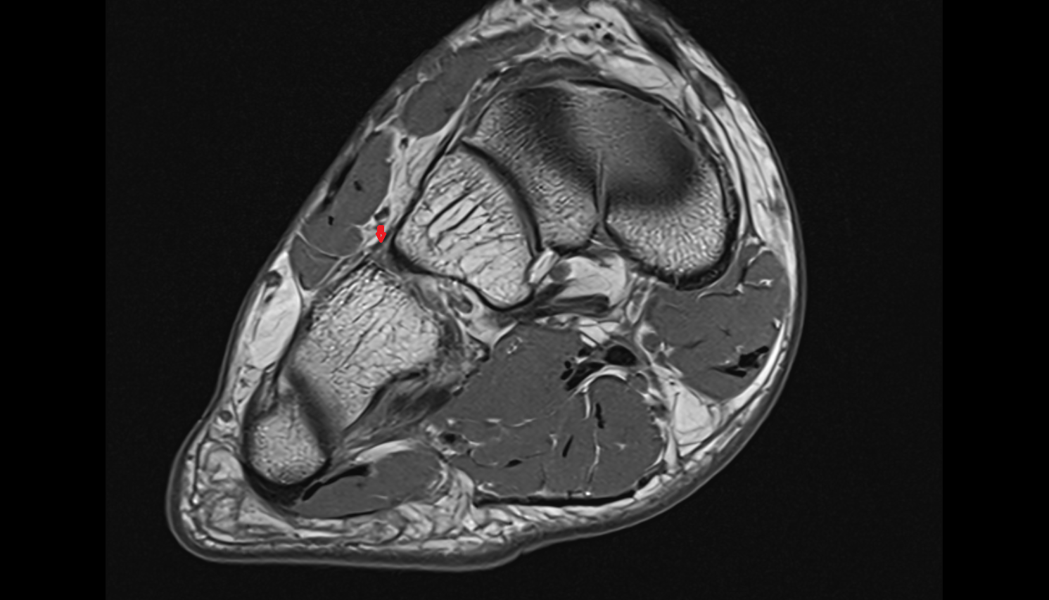 dorsal cuneocuboid ligament axial  cross sectional anatomy 3T MRI AI enhanced radiology image-img-00000-00000_00001