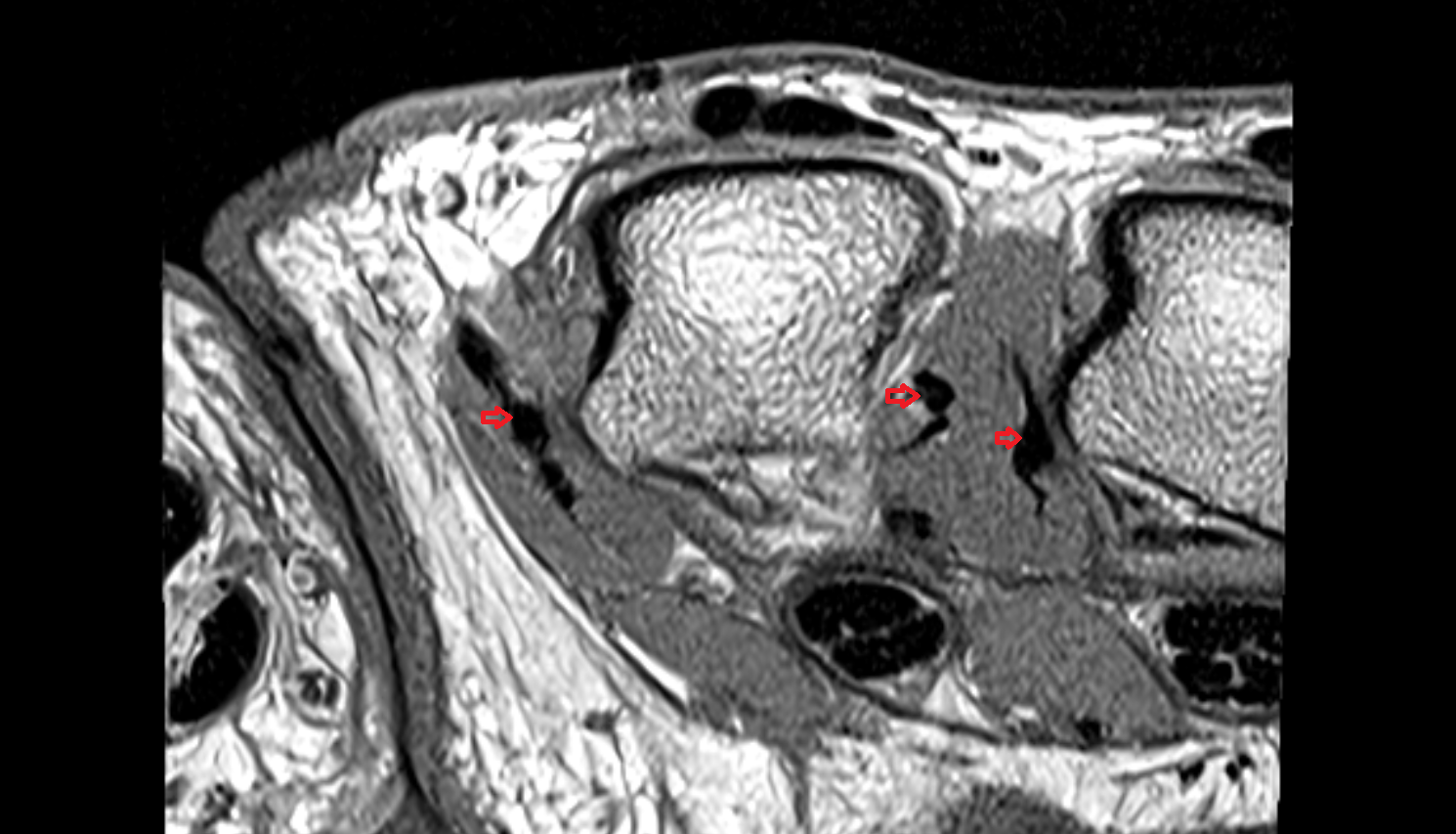 dorsal interossei tendon  hand  MRI axial  image-img-00000-00000