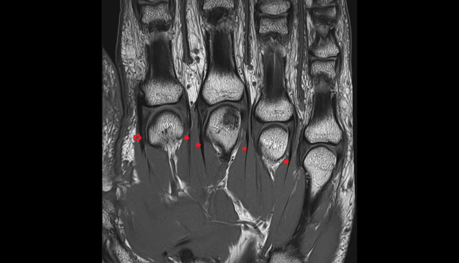 dorsal interossei tendon  hand  MRI axial  image-img-00000-00000_00001