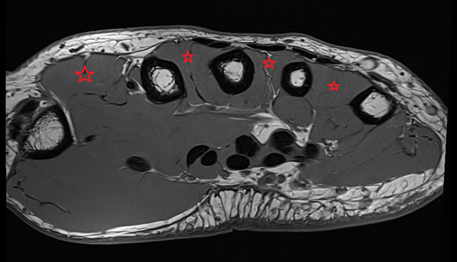 dorsal interosseous muscles of hand axial cross sectional anatomy 3T MRI AI enhanced radiology image-img-00000-00000