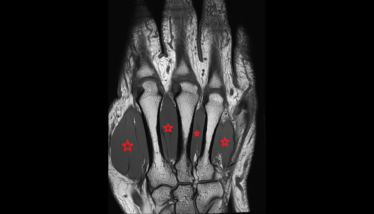 dorsal interosseous muscles of hand coronal cross sectional anatomy 3T MRI AI enhanced radiology image-img-00000-00000