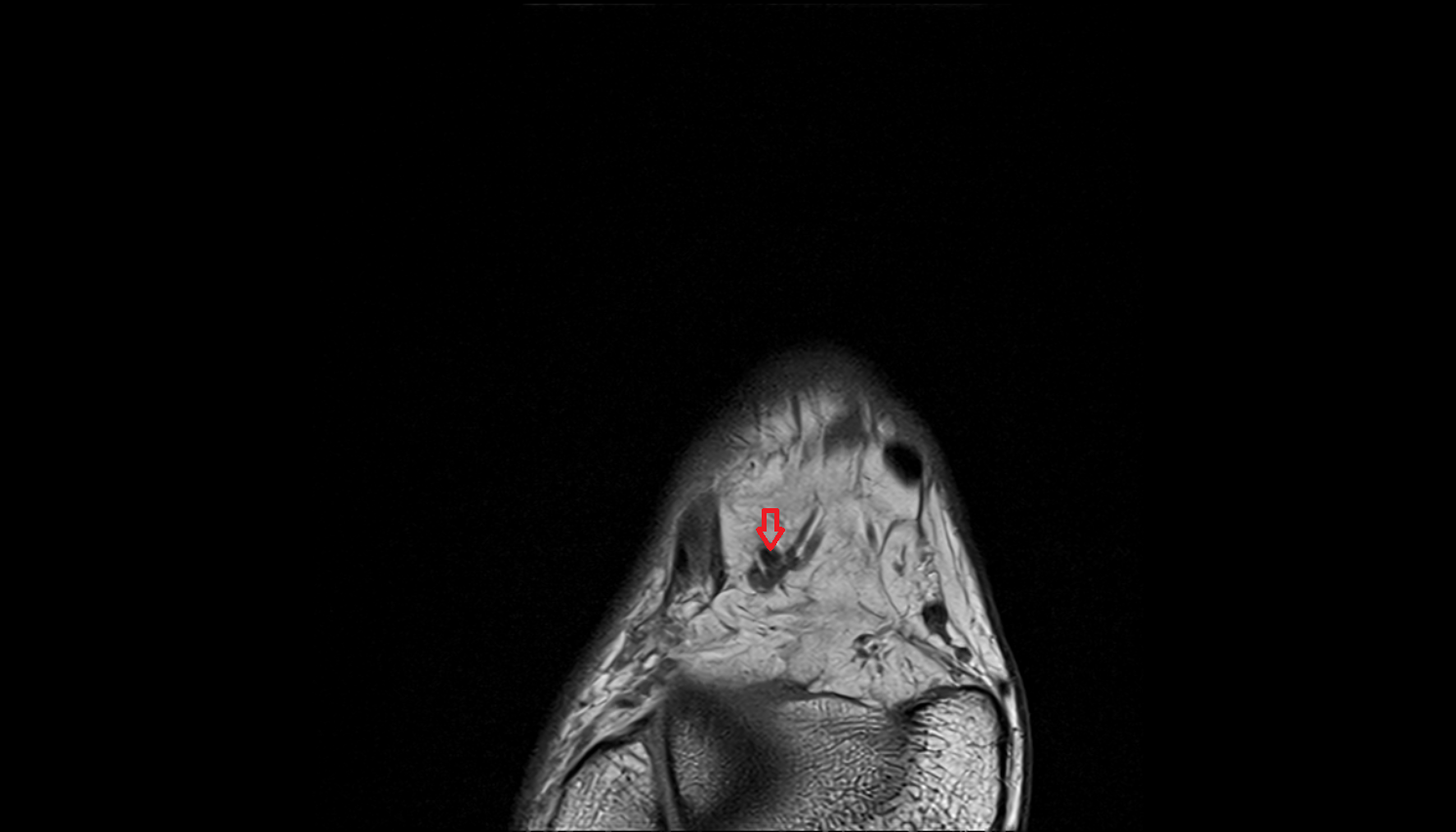 dorsalis pedis artery  axial  cross sectional anatomy 3T MRI AI enhanced radiology image-img-00000-00000