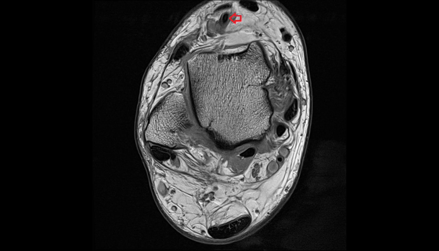 dorsalis pedis artery  axial  cross sectional anatomy 3T MRI AI enhanced radiology image-img-00000-00000_00001