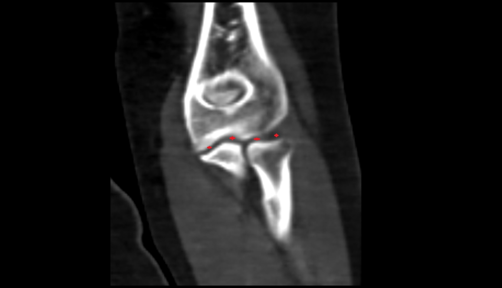 elbow joint ct image