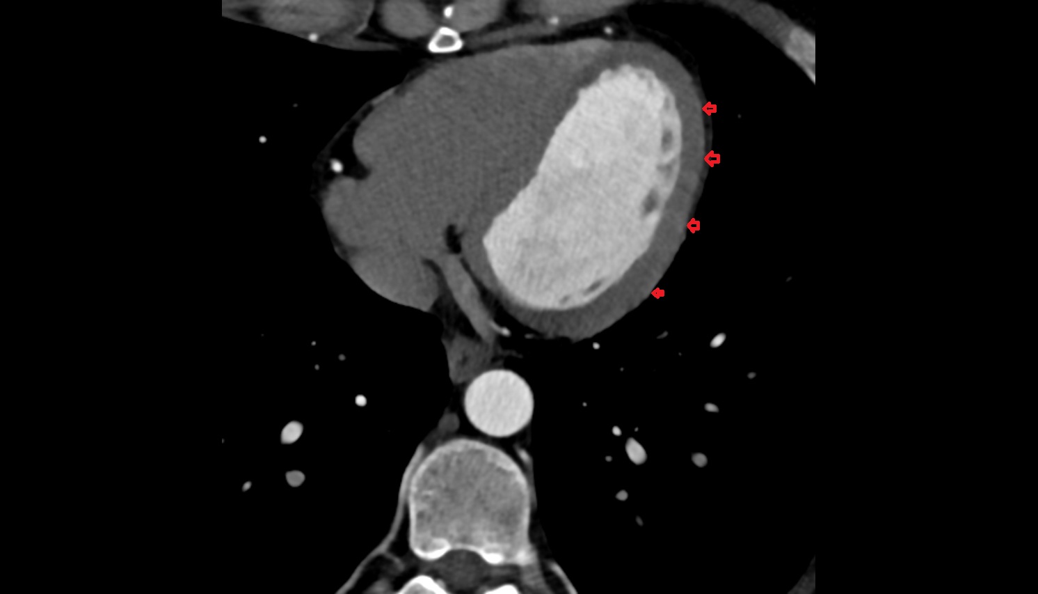 epicardium anatomy CT axial image -img-00000-00000
