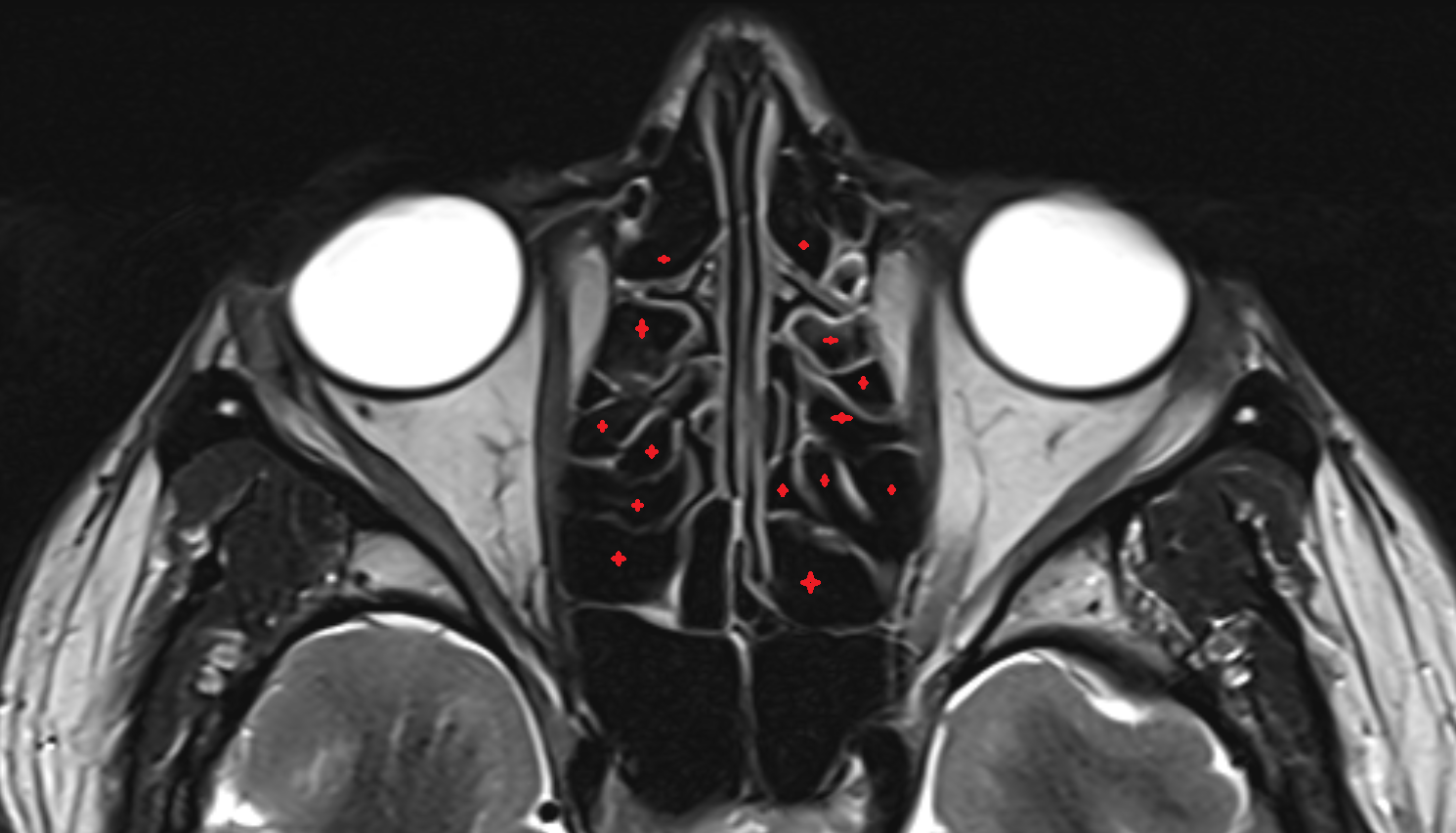 ethmoidal air cells axial mri image-img-00000-00000