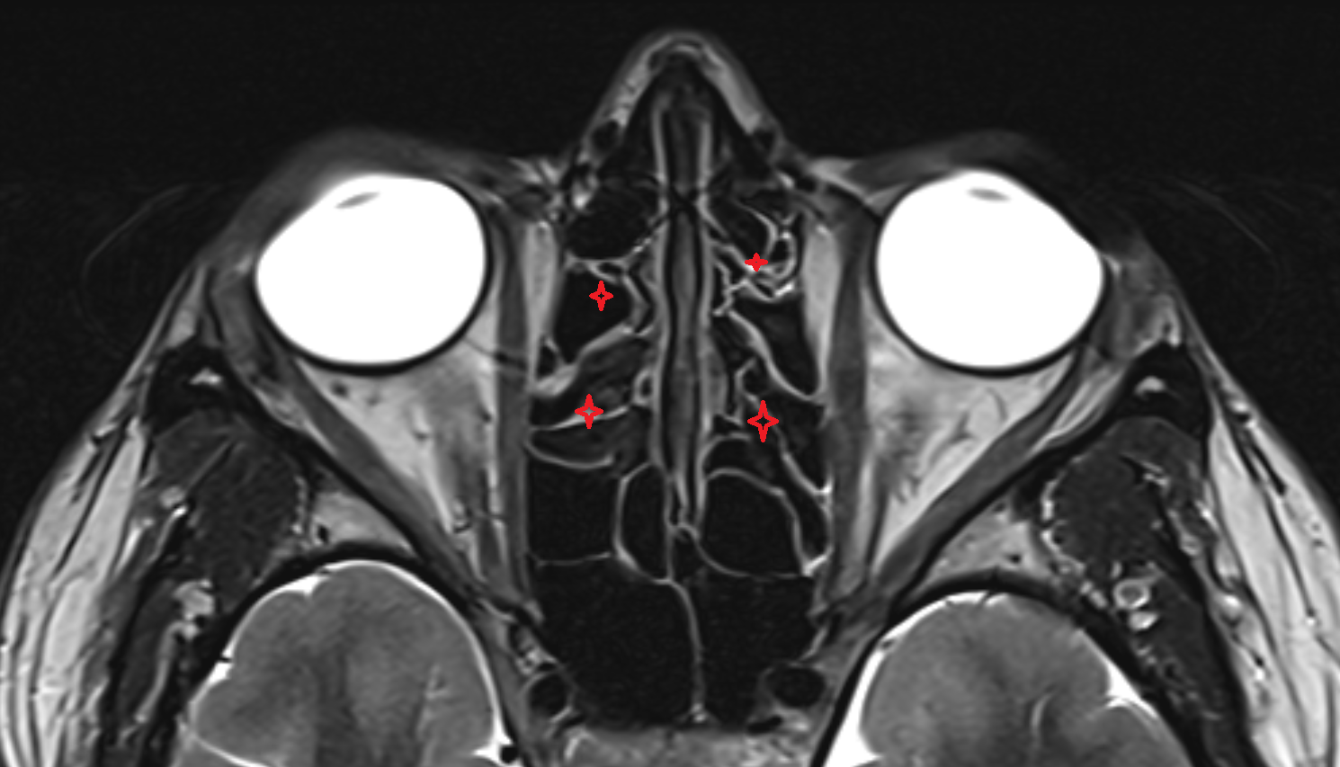 ethmoid sinus axial mri image-img-00000-00000