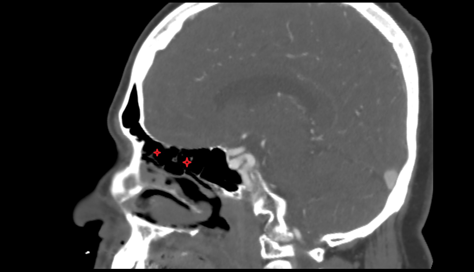 ethmoid sinus ct sag image