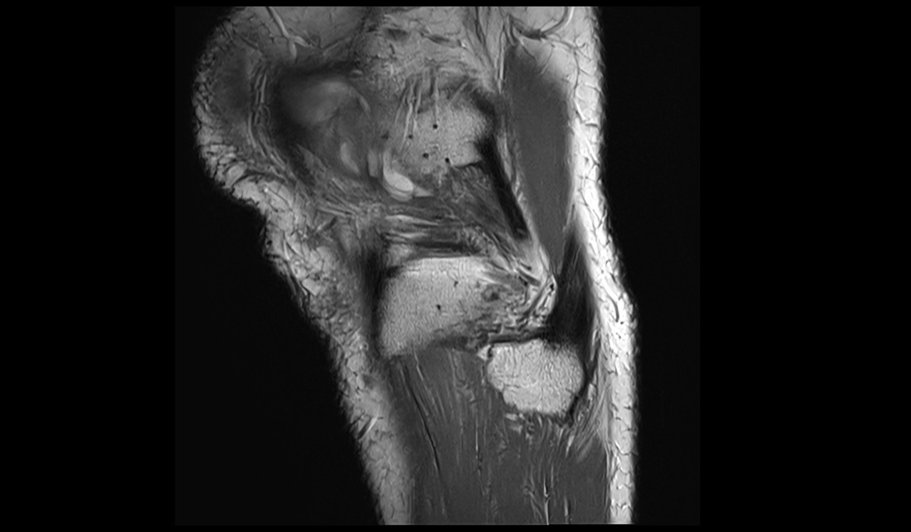 extensor digitorum longus