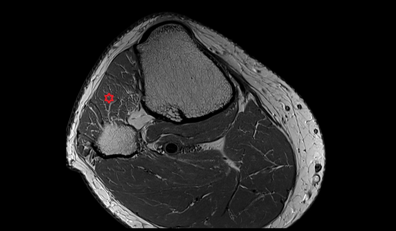 extensor digitorum longus muscle anatomy 3t mri image