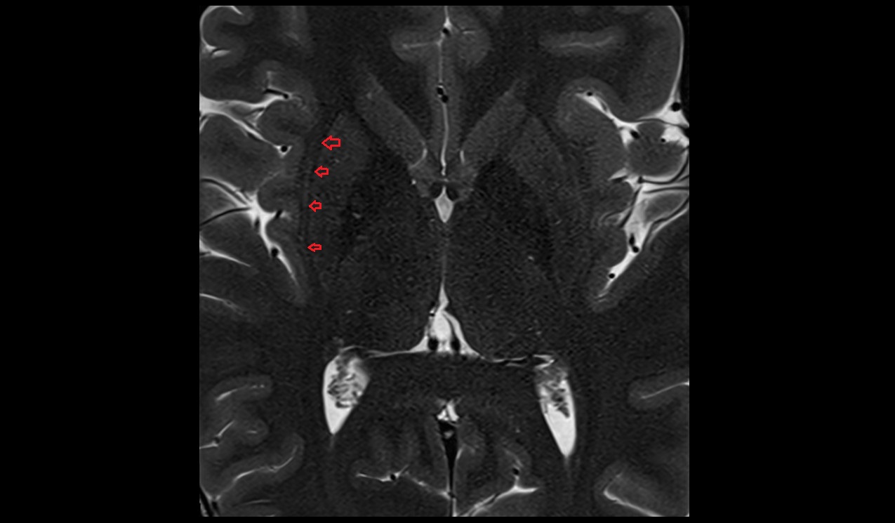 external capsule mri 3t axial  image