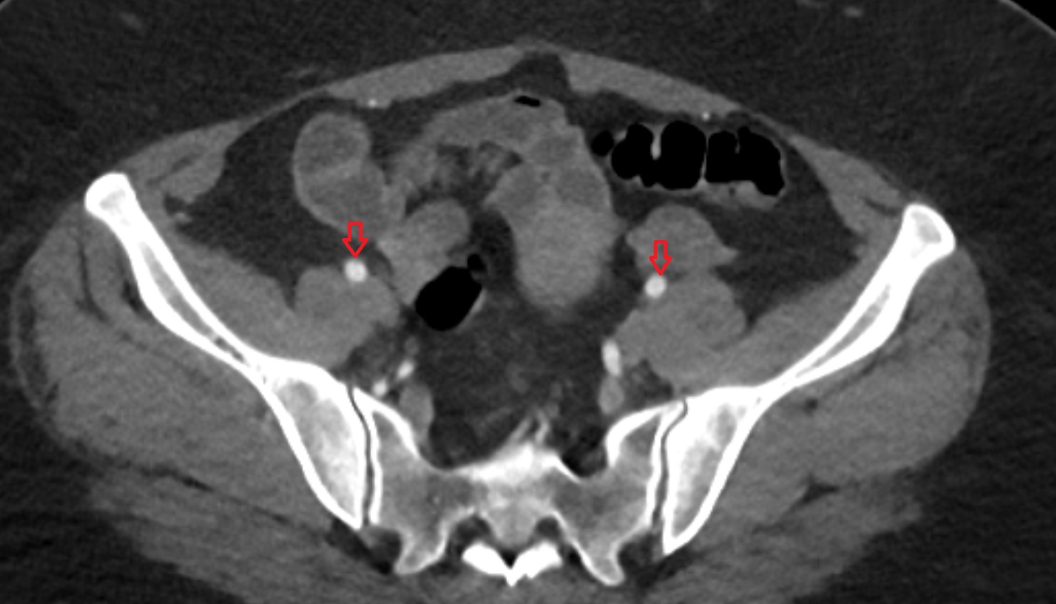 external iliac artery  CT axial image  MRI  axial  anatomy  image-img-00000-00000