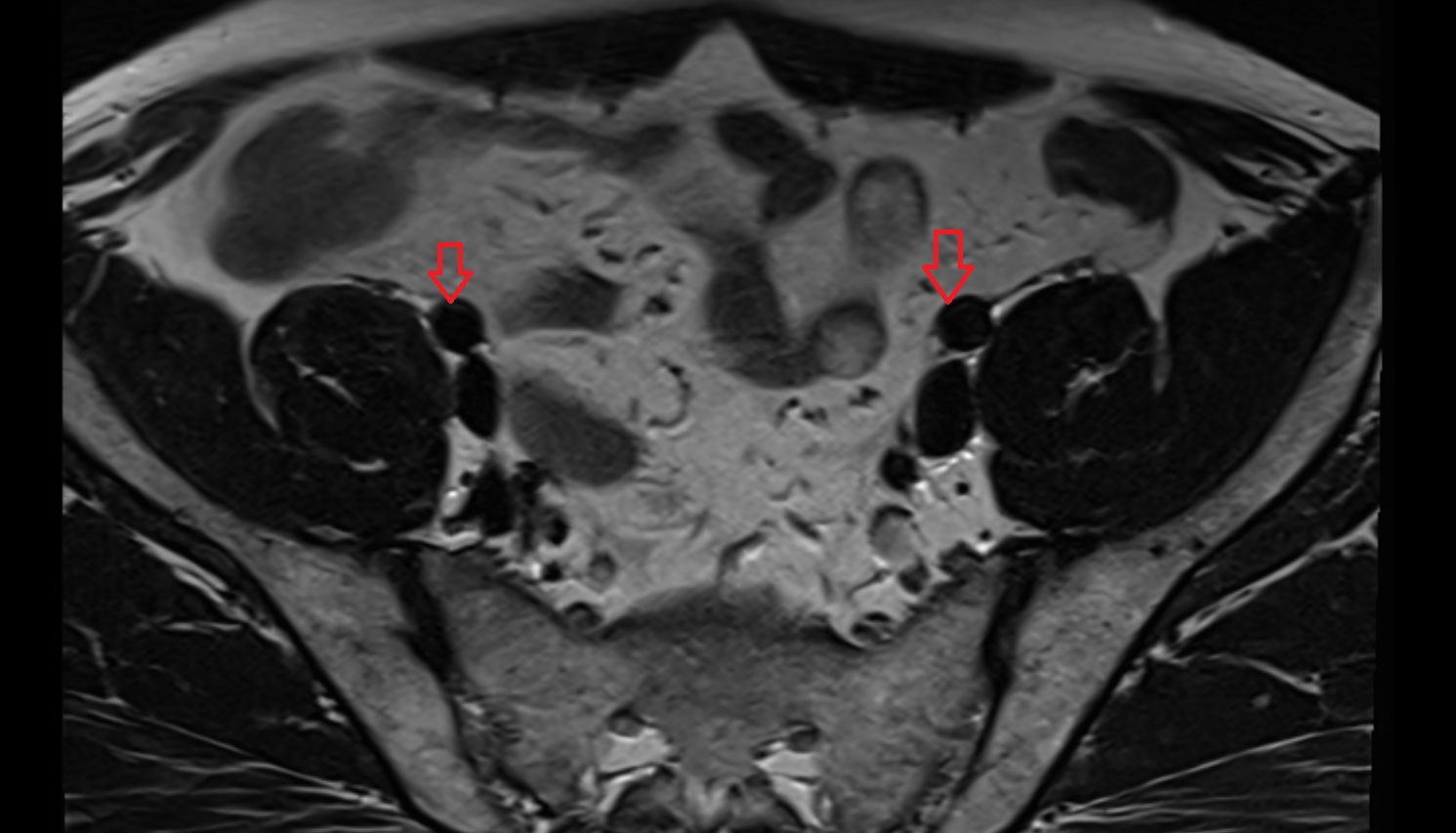 external iliac artery  MRI axial image  MRI  axial  anatomy  image-img-00000-00000