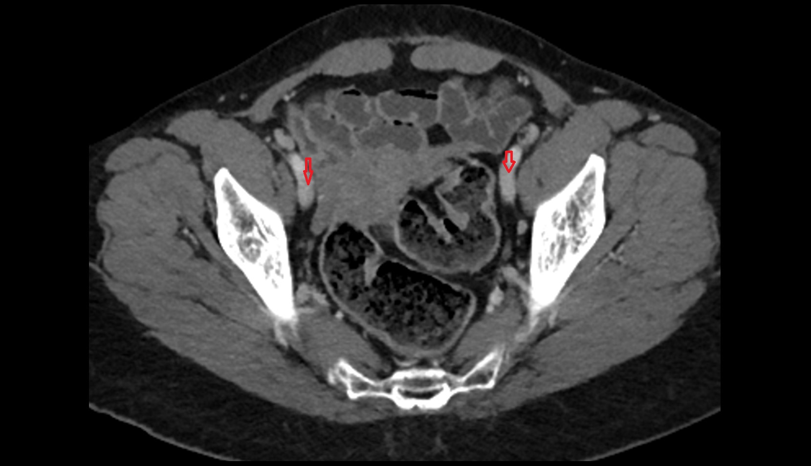 external iliac vein CT axial image