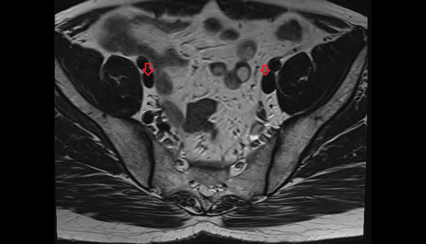 external iliac vein  MRI  axial  anatomy  image-img-00000-00000