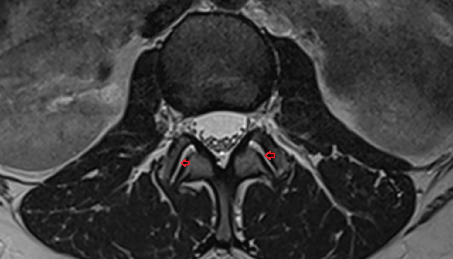 facet joint of of vertebra  mri axial  image -img-00000-00000_00001