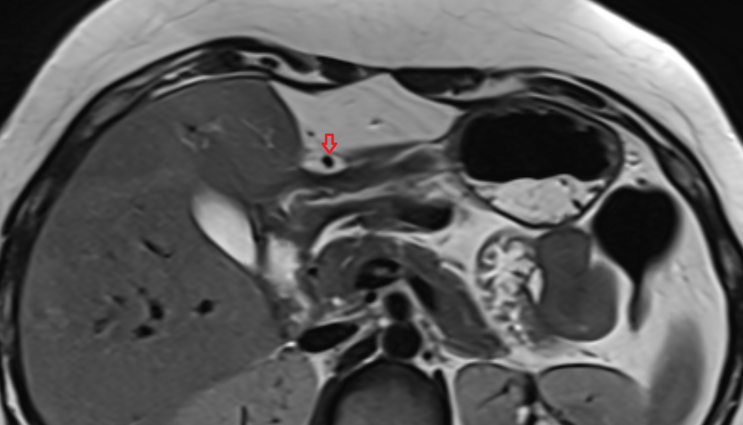 falciform ligament liver   MRI axial  anatomy  image -img-00000-00000