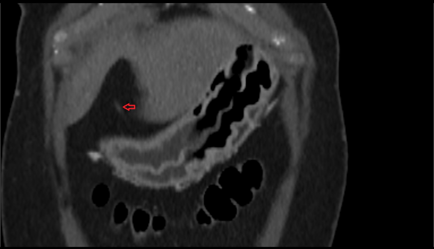 falciform ligament liver coronal image