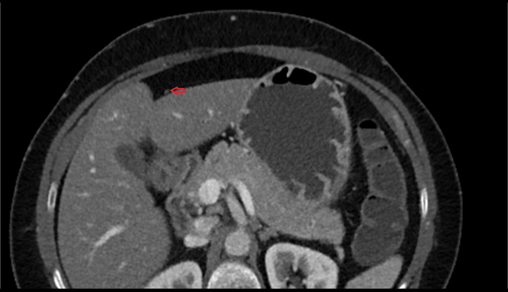 falciform ligament liver ct axial image