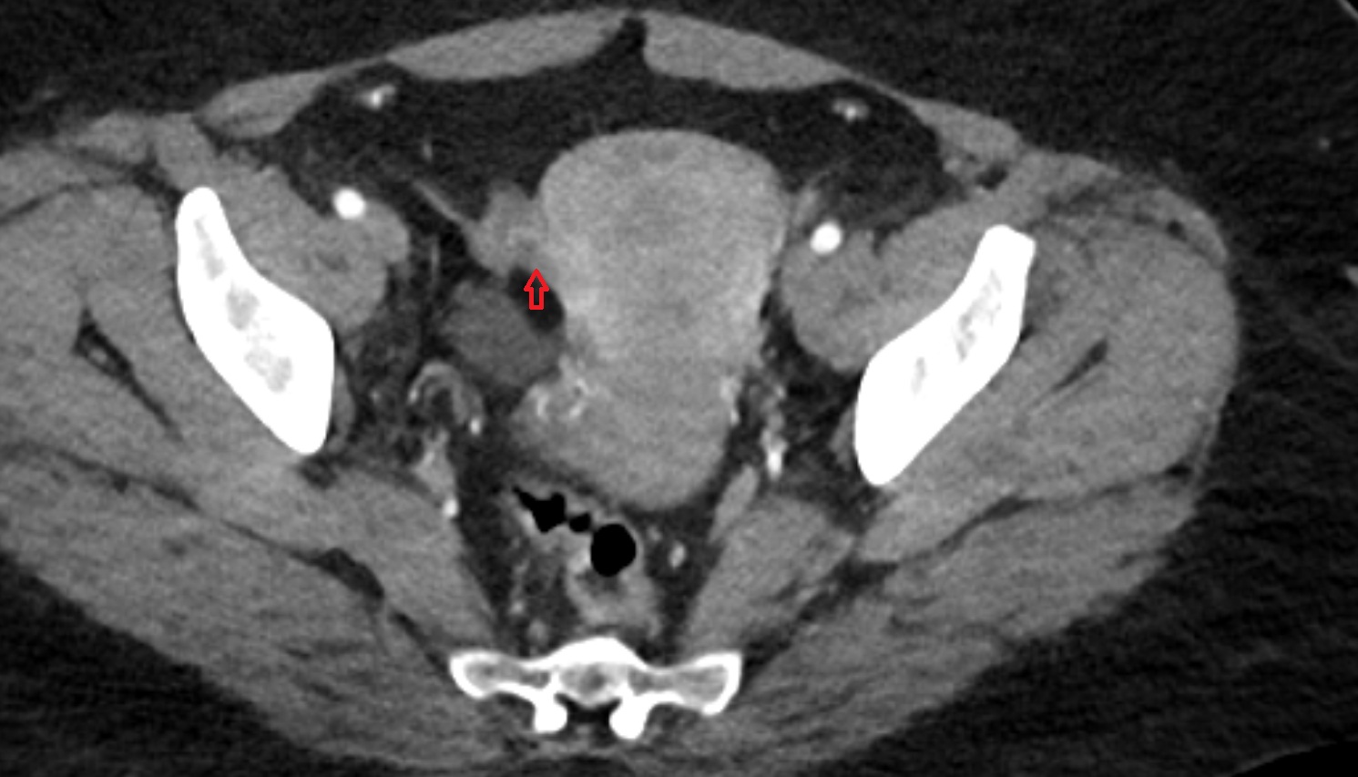 fallopian tube  CT  axial  image anatomy  image-img-00000-00000