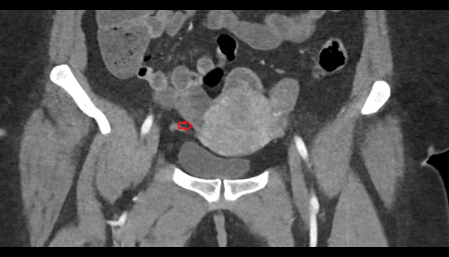 fallopian tube  CT  coronal  image anatomy  image-img-00000-00000