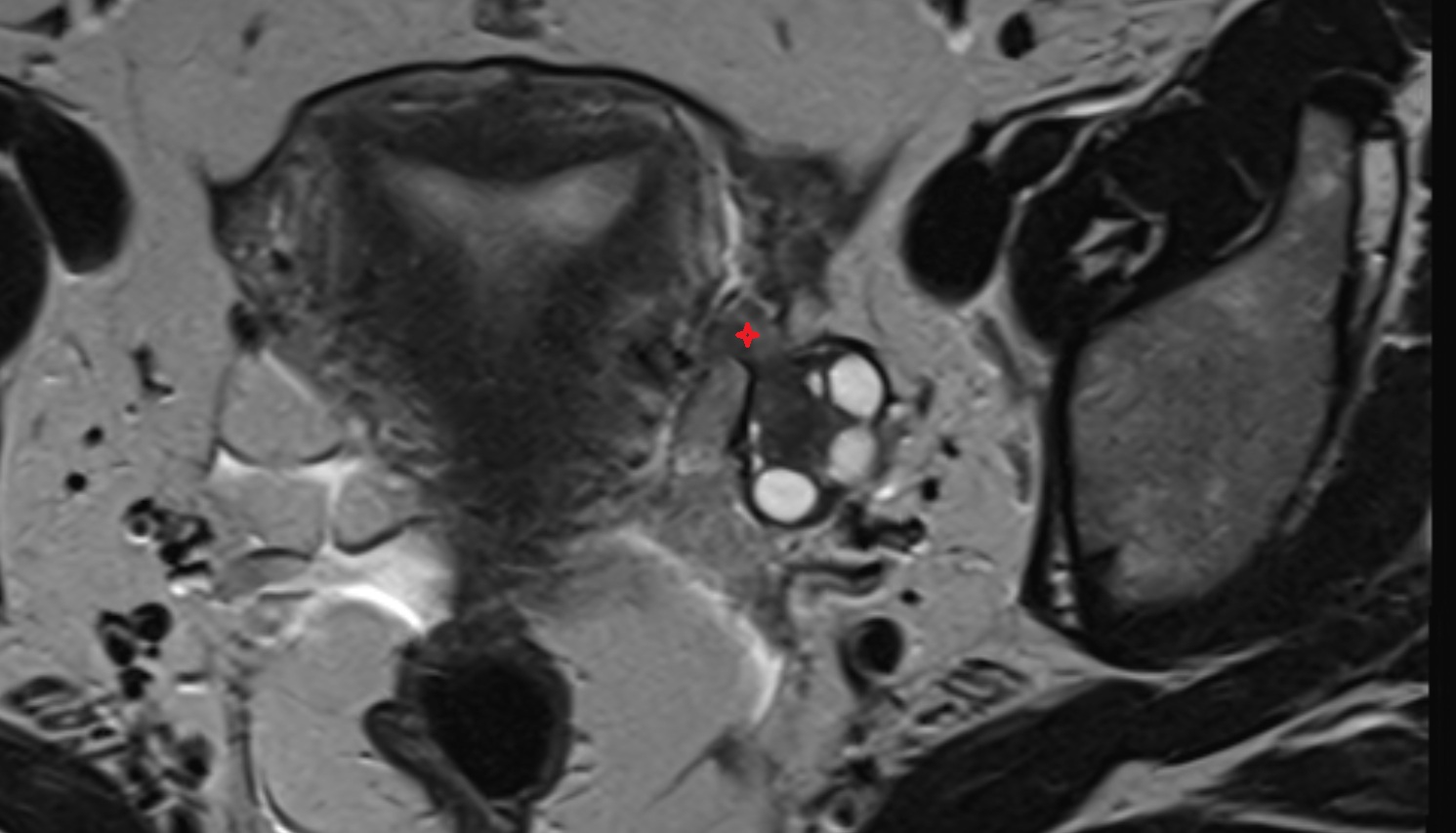 fallopian tube  MRI  axial  image anatomy  image-img-00000-00000