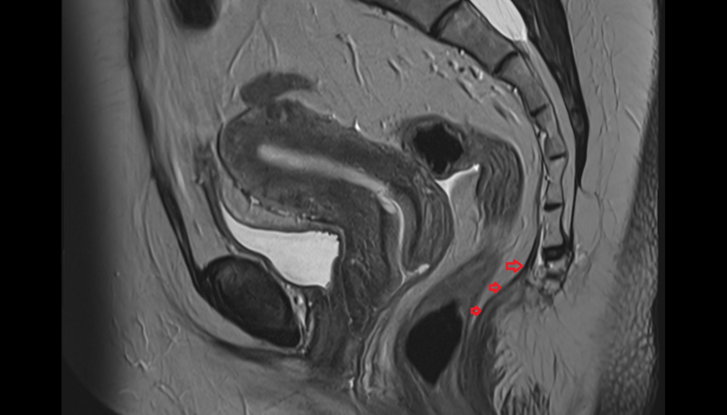 fascia of pelvic diaphragm  MRI sagital  anatomy  image-img-00000-00000