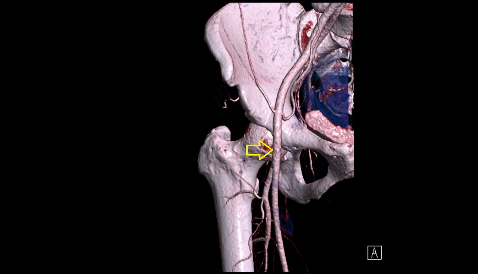 femoral artery  CT 3D VRT anatomy image