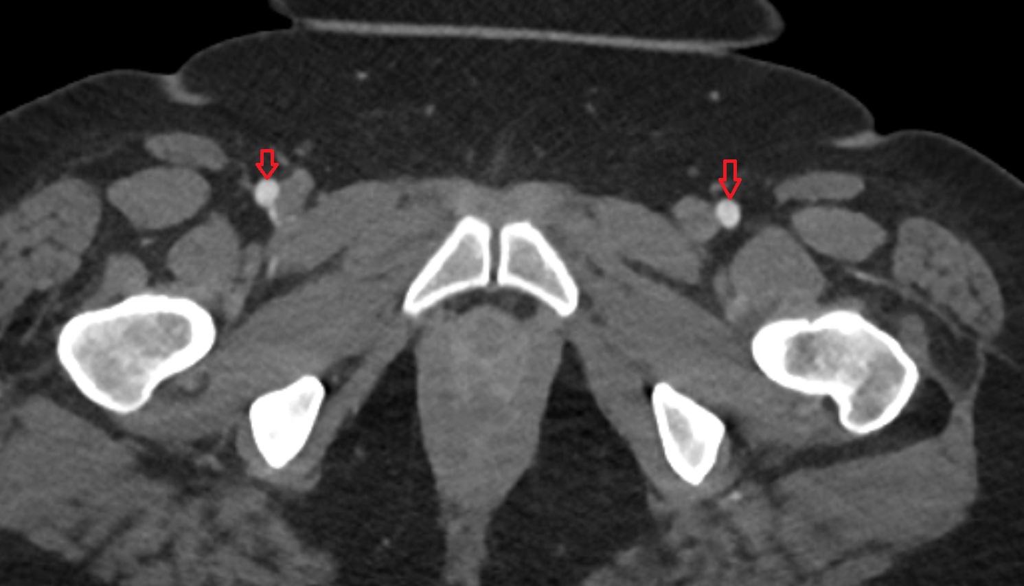 femoral artery  CT axial image  MRI  axial  anatomy  image-img-00000-00000