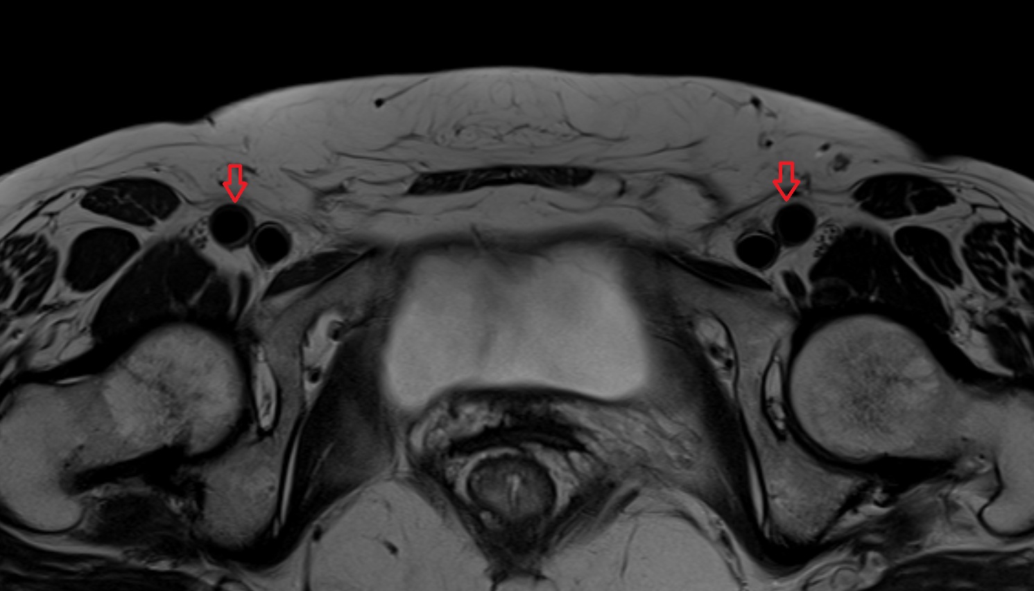 femoral artery  MRI  axial  anatomy  image-img-00000-00000