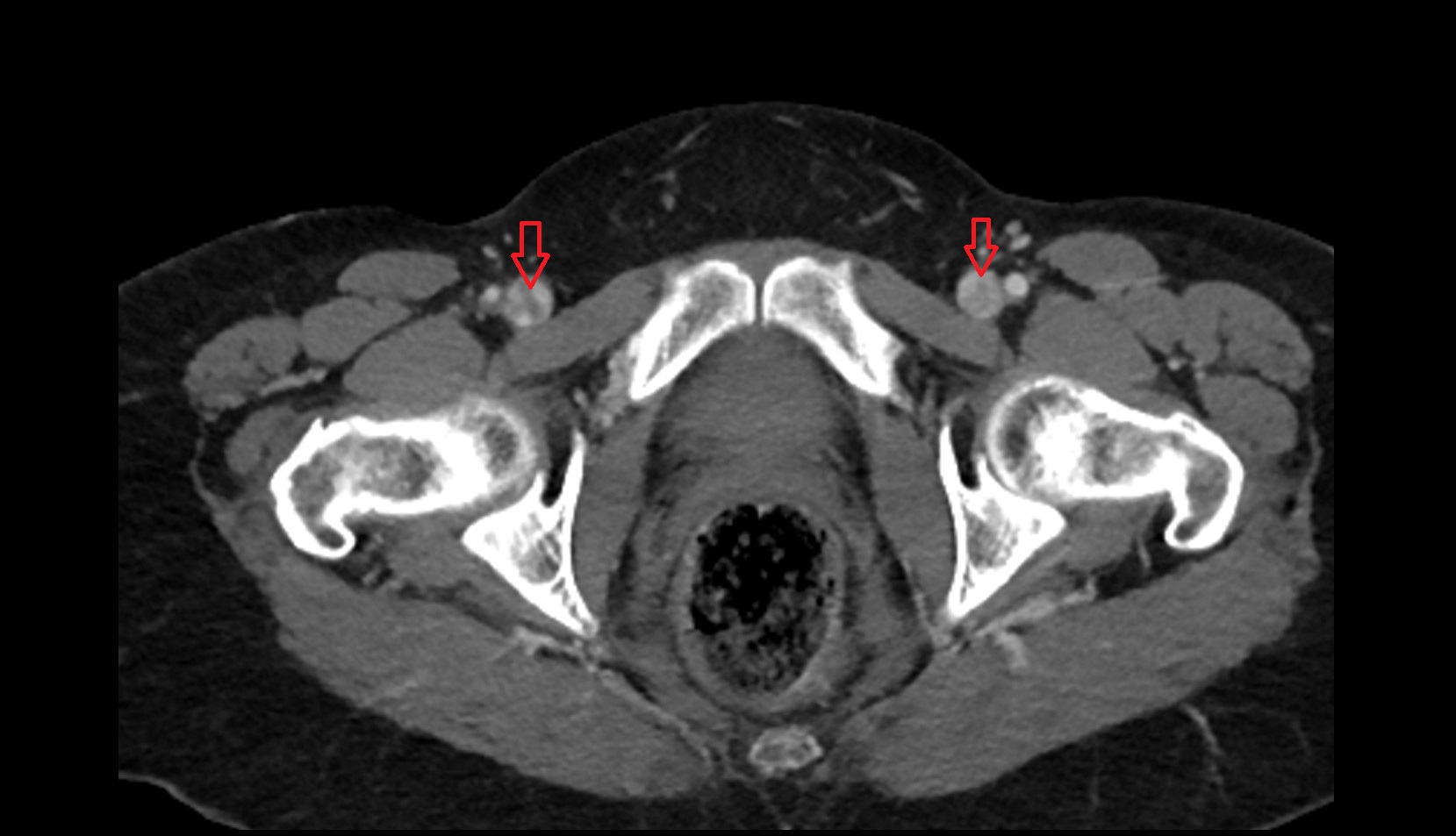 femoral vein CT axial image