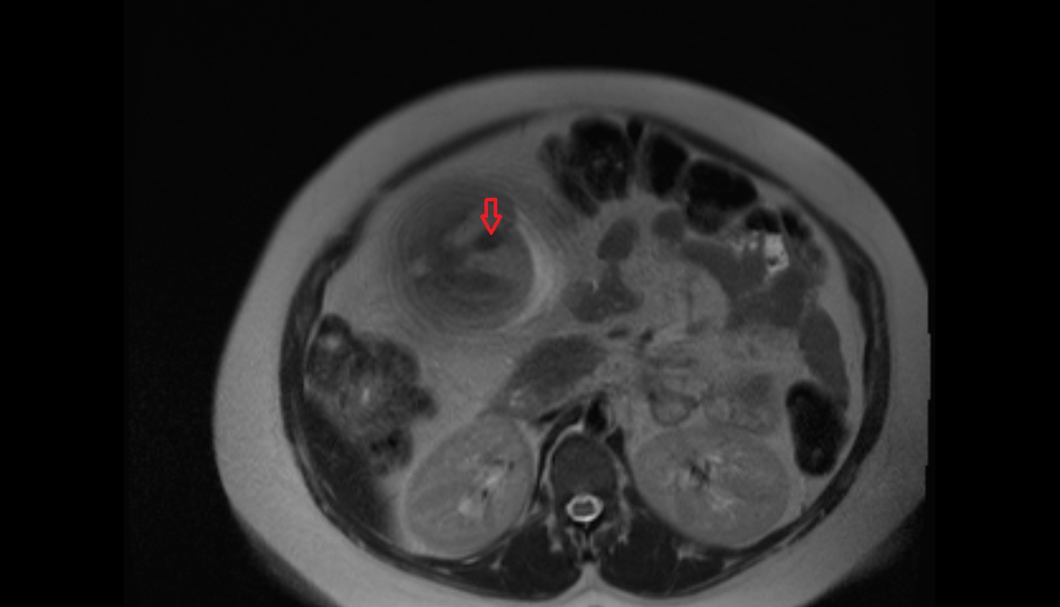 fetal Anus  MRI axial  anatomy image-img-00000-00000