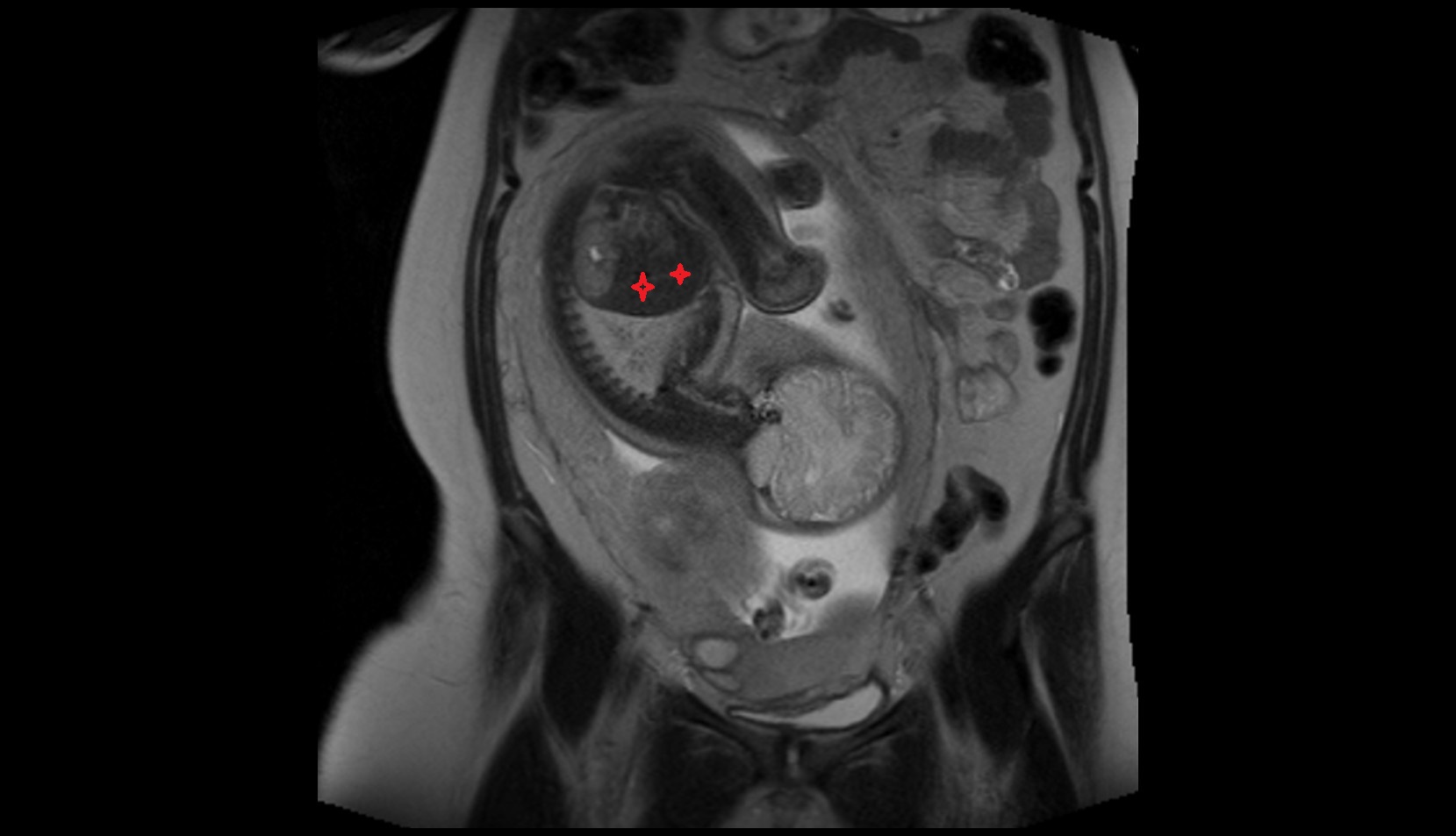 fetal Liver mri coronal image