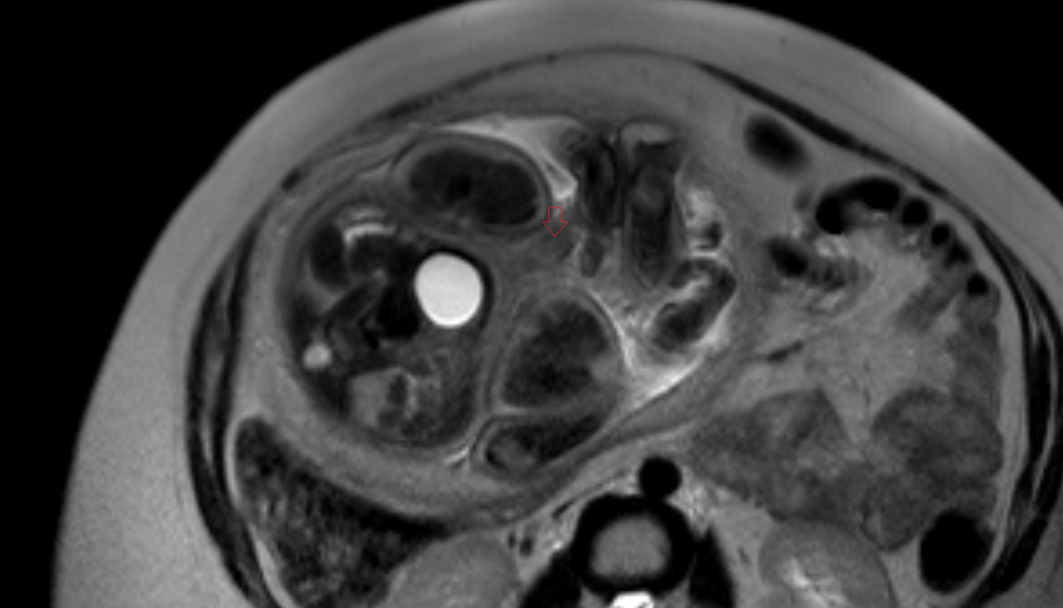 fetal Penis  MRI axial  anatomy image-img-00000-00000
