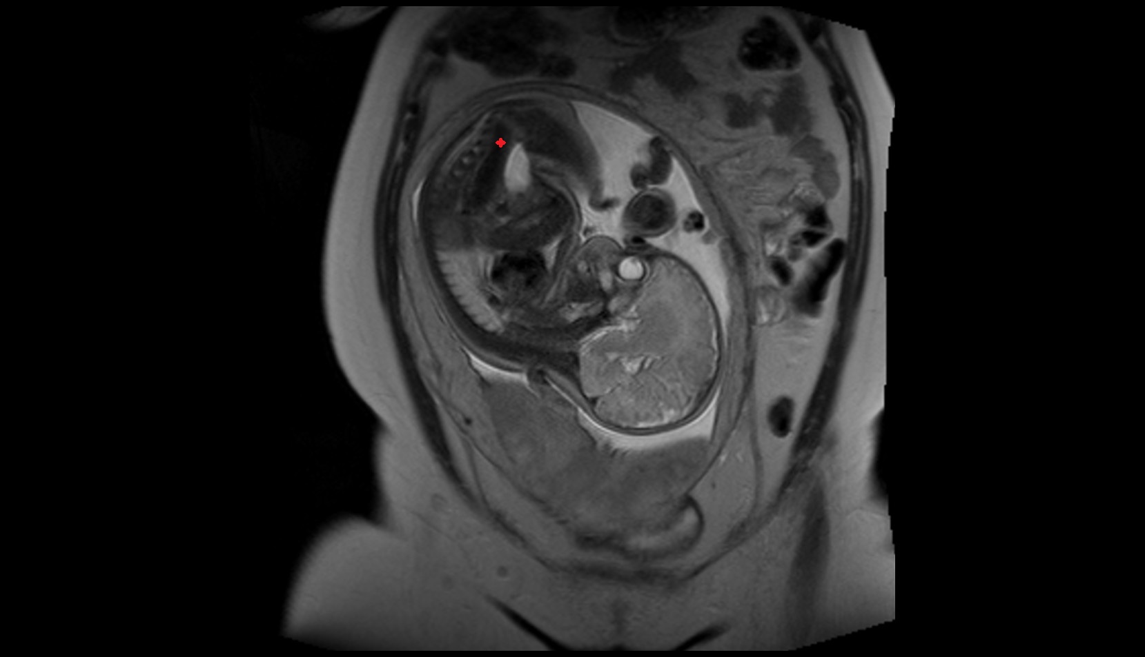 fetal Rectum mri image