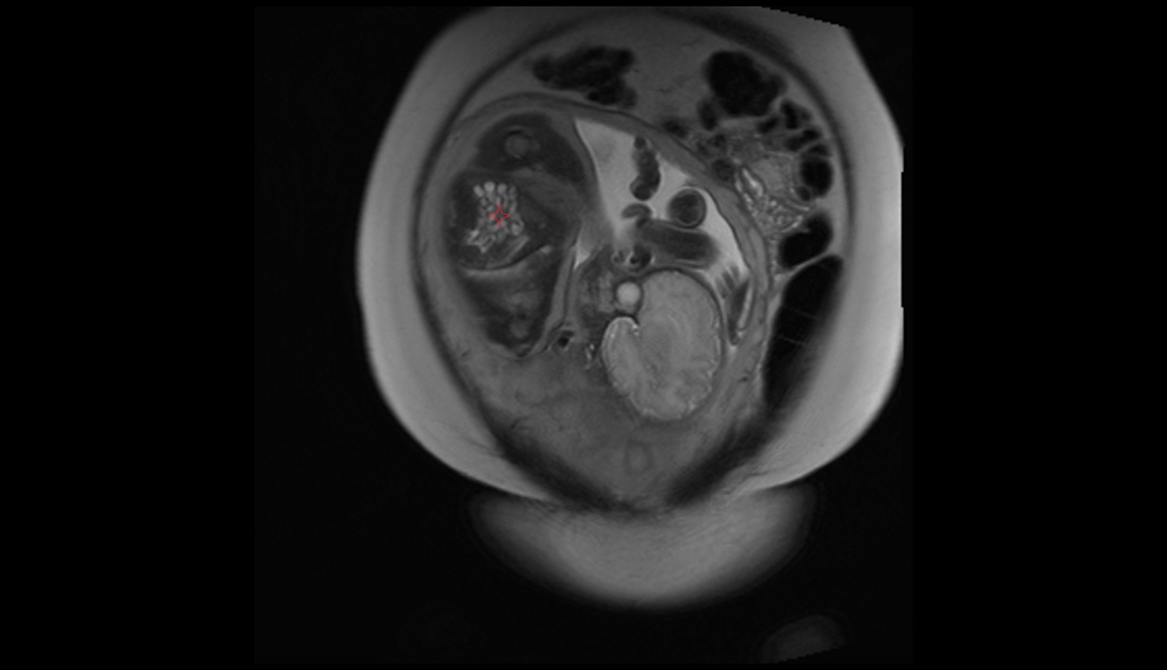 fetal Small bowel MRI CORONAL