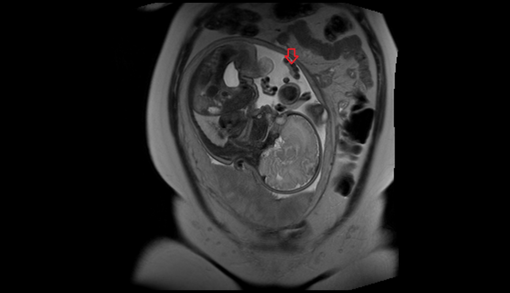 fetal hand mri coronal image
