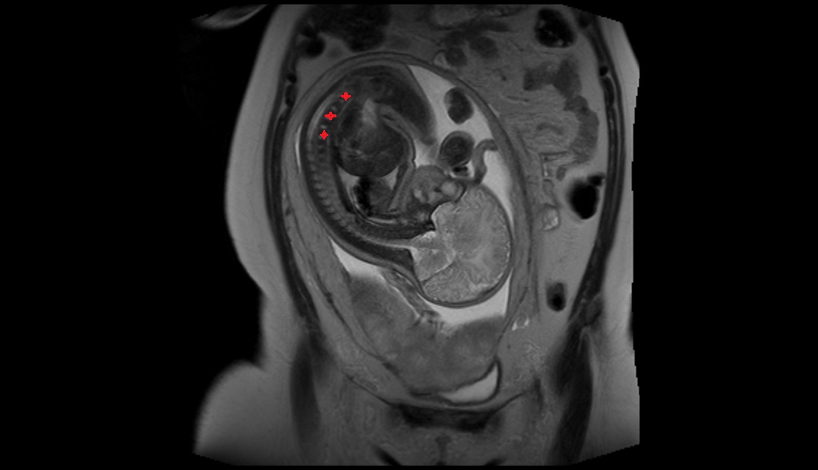 fetal lumbar spine MRI IMAGE