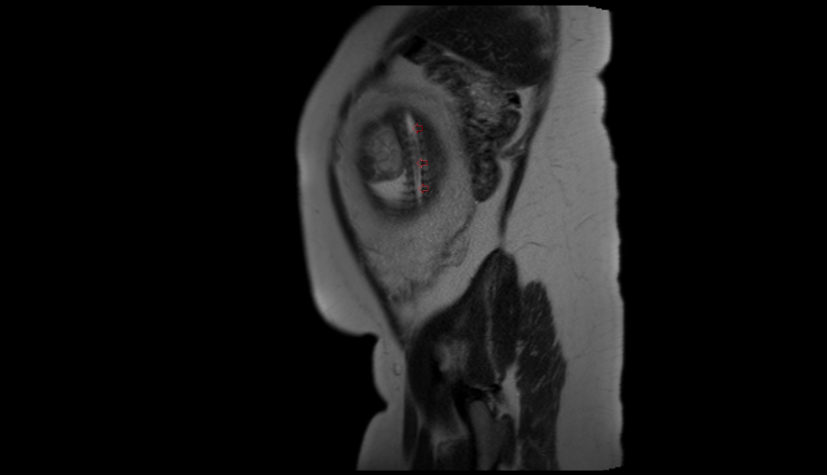 fetal spinal canal MRI SAG IMAGE
