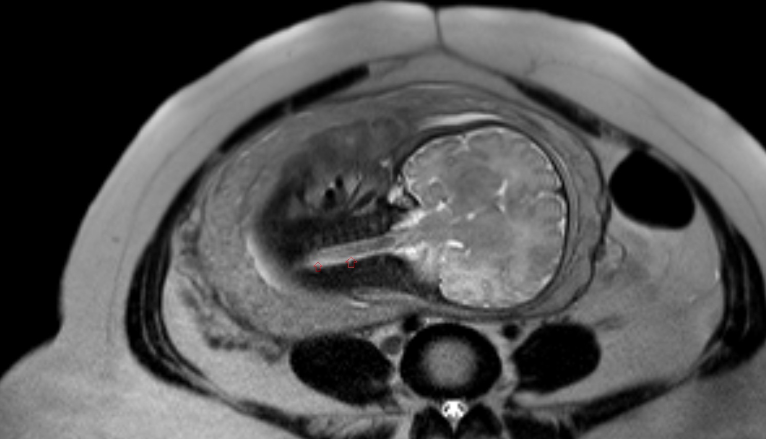 fetal spinal canal  MRI axial  anatomy image-img-00000-00000
