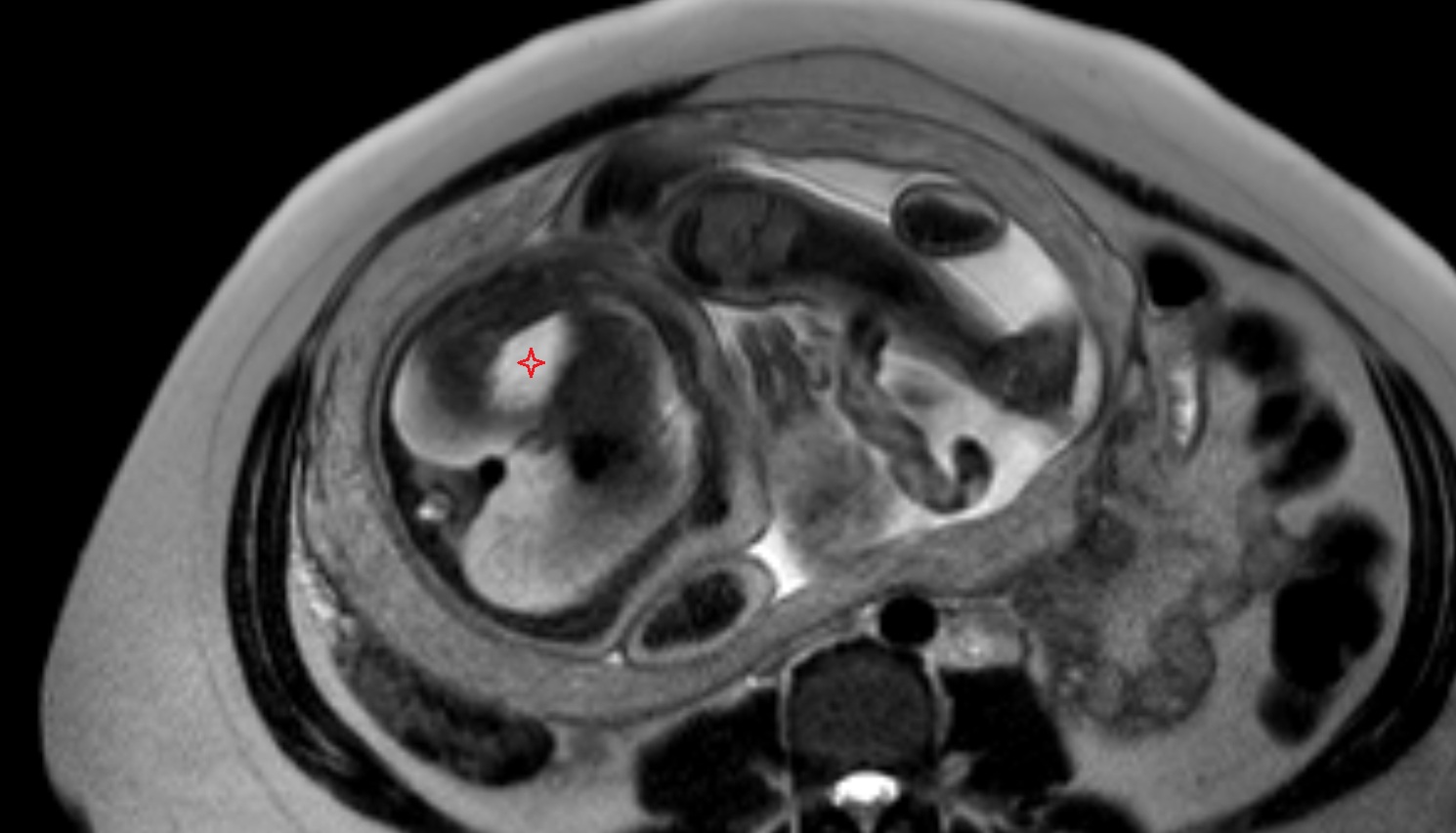 fetal stomach  MRI axial  anatomy image-img-00000-00000