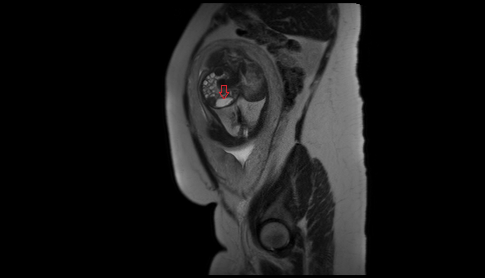 fetal stomach mri sag image