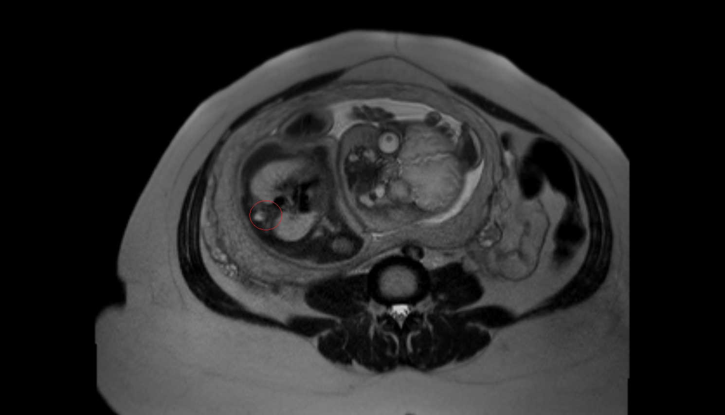 fetal thoracic spine  MRI coronal  anatomy image-img-00000-00000