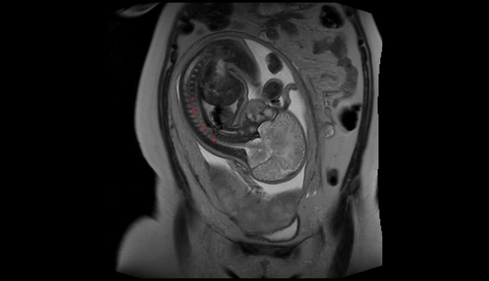 fetal thoracic spine mri sag image